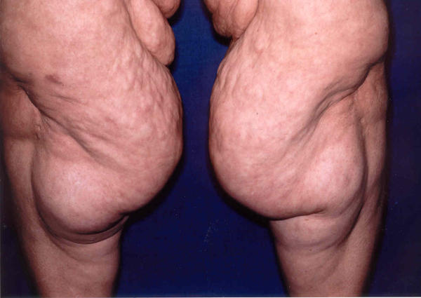 Loose skin on online thighs after weight loss